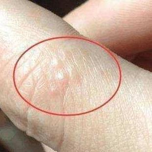 脚上起小水泡还很痒是怎么回事？一文读懂原因与应对方法
